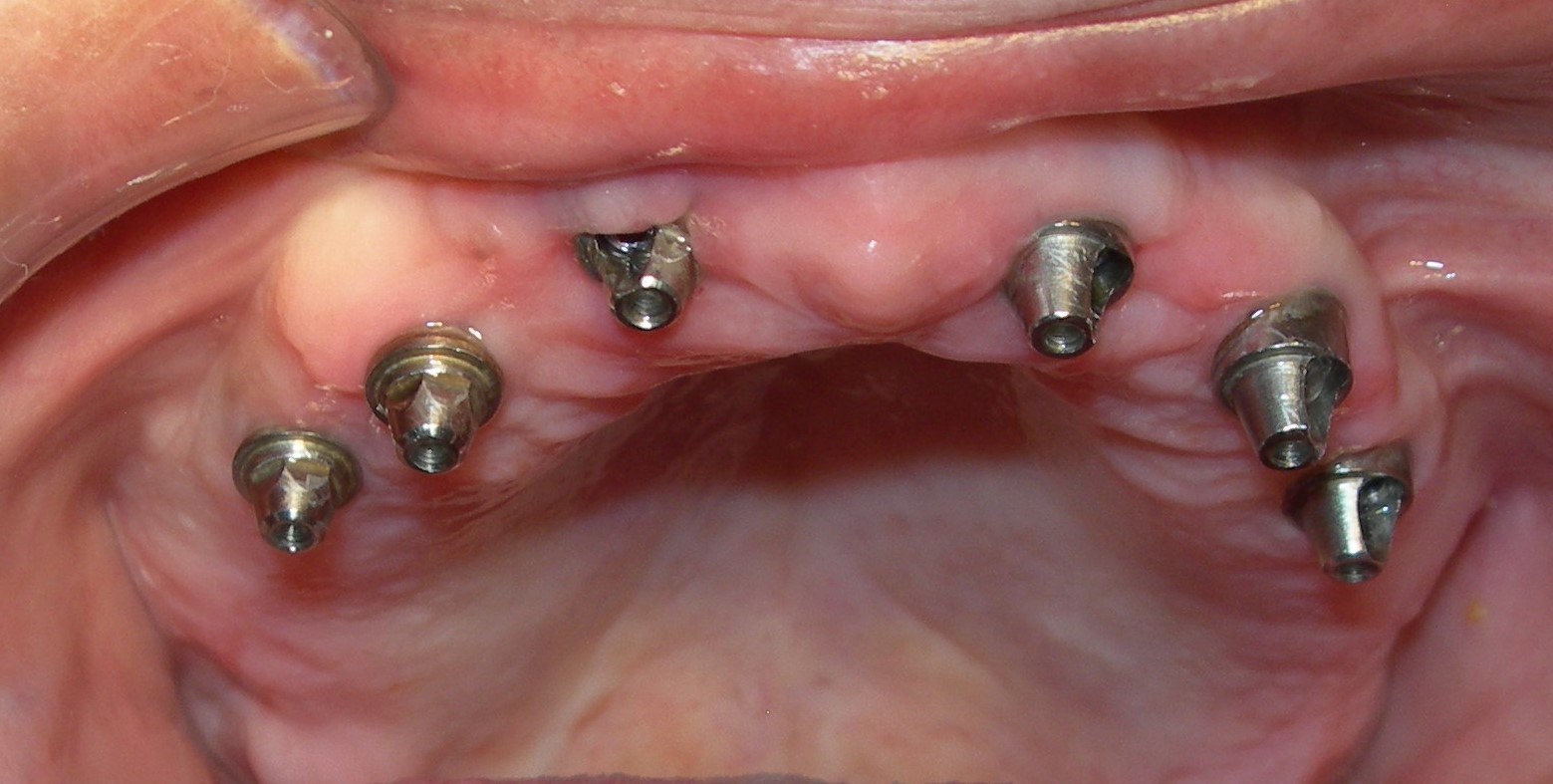 İmplant Vidalı Sistem Öncesi